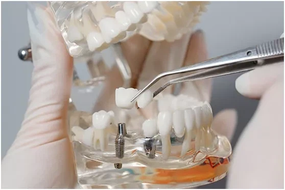 Dental Implants Dental Implants